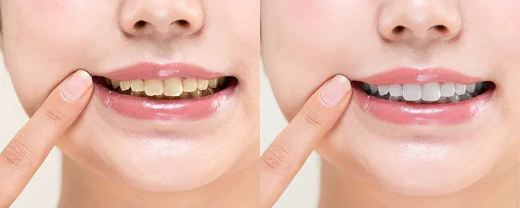 歯が黄ばむ原因とは…？